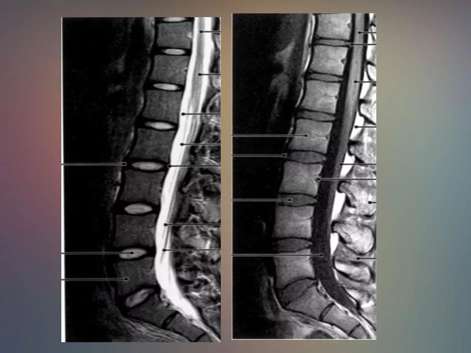 腰椎退行性变腰痛的mr诊断丨影像天地