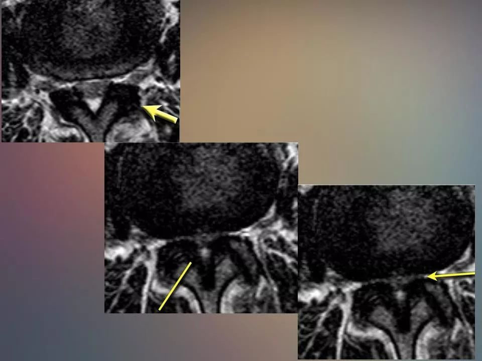 腰椎退行性变腰痛的mr诊断丨影像天地