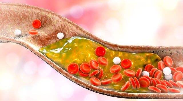 低密度胆固醇和高密度胆固醇过高 7b992789f5274ed2b389664aaecb5fa1.jpeg