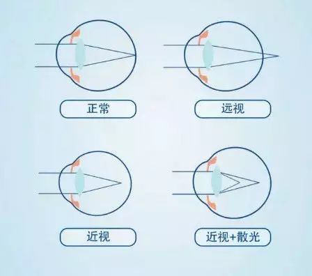 为啥 你的 眼睛会 散光?