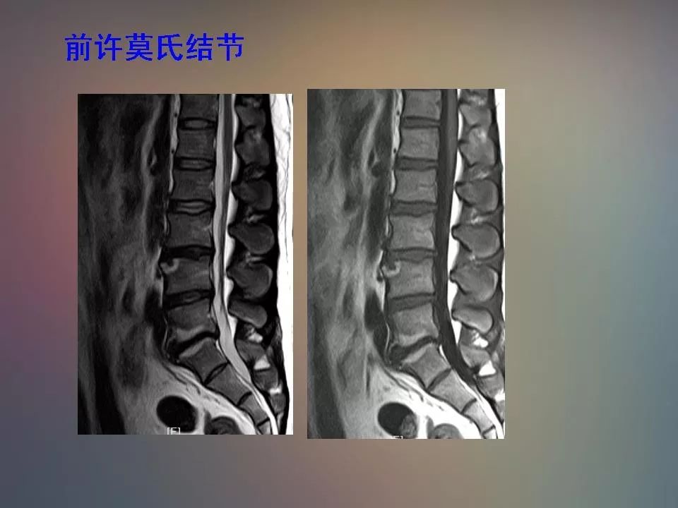 腰椎退行性变腰痛的mr诊断丨影像天地