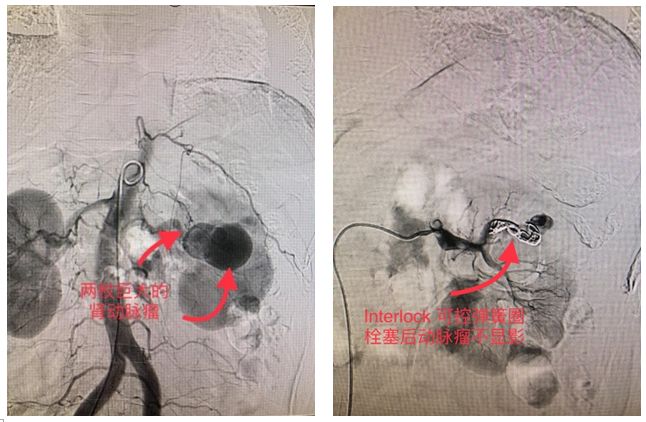 介入栓塞术为新发展的一种治疗内脏动脉瘤的有效方法,避免了开放手术