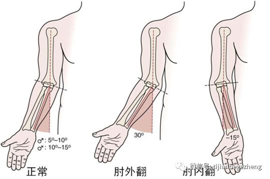 121招飞体检可以接受肘外翻吗