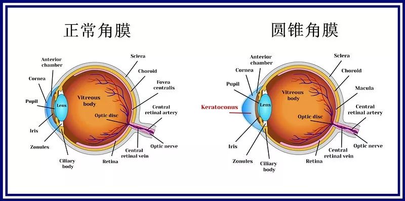 看了圆锥角膜的图片网友表示外观很漂亮但能正常睁眼闭眼吗