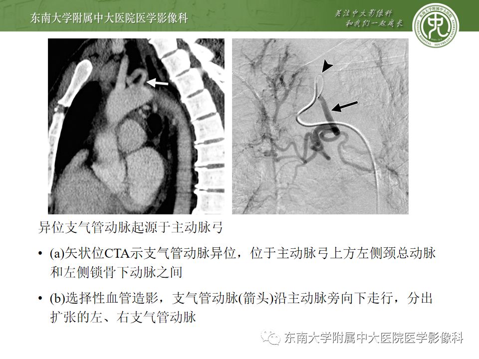 支气管动脉解剖及异常影像表现