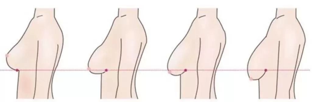 胸下垂一般分为三种情况,位置性乳房下垂,体积性乳房下垂,乳房皮肤性