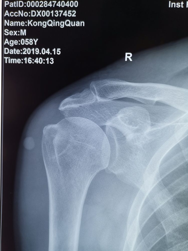 山医大一院运动医学团队肩关节篇——关节镜微创治疗肩袖损伤
