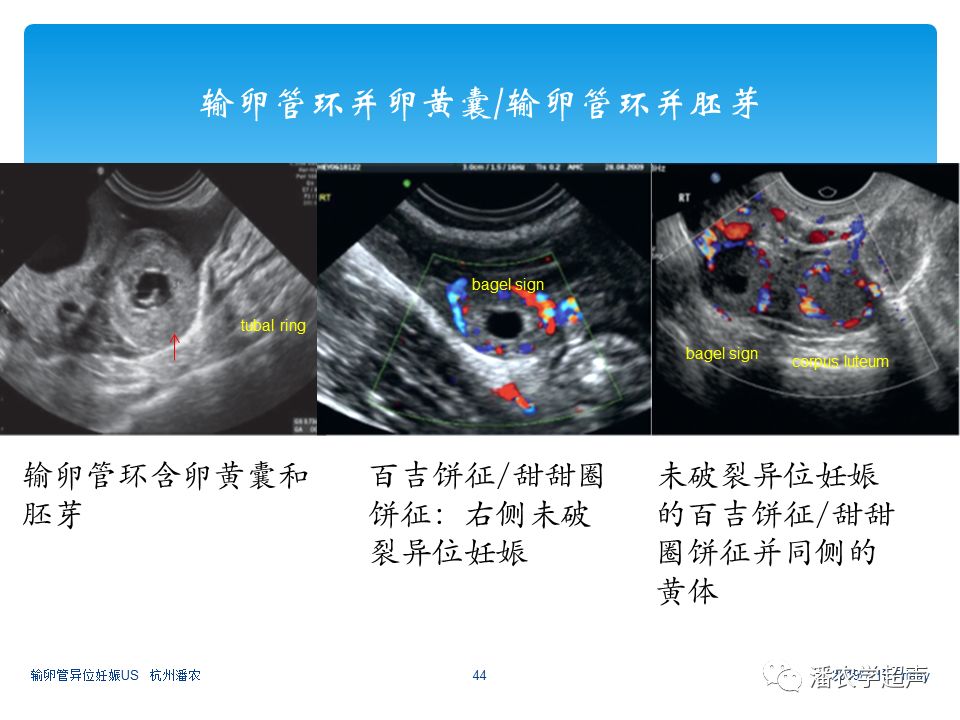 【超声微课堂】输卵管异位妊娠超声诊断思路