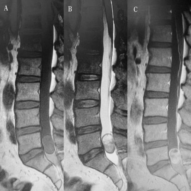 术前腰椎磁共振:a,mri t1序列,见肿瘤位于腰5骶1椎体水平膜内,边界