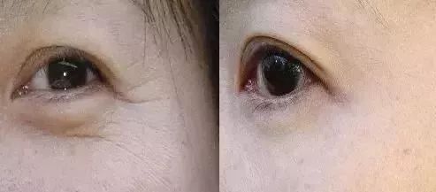 眼袋松弛下垂,切记不要动手术!用这个,每天几块