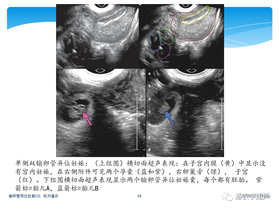 【超声微课堂】输卵管异位妊娠超声诊断思路