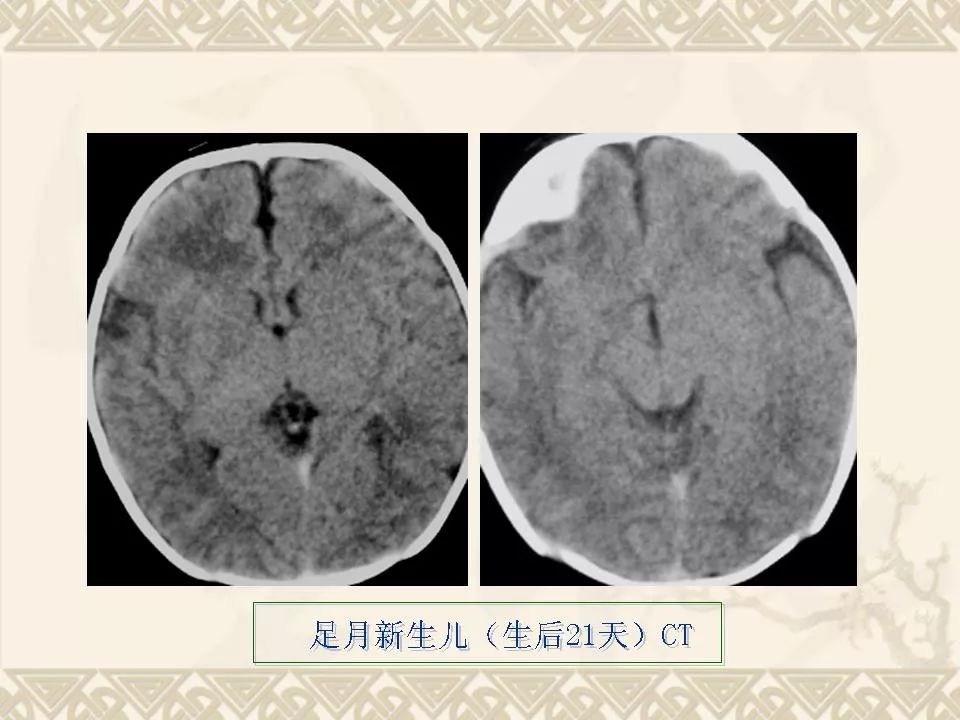 新生儿缺氧缺血或窒息所致脑损伤的影像学诊断丨影像天地