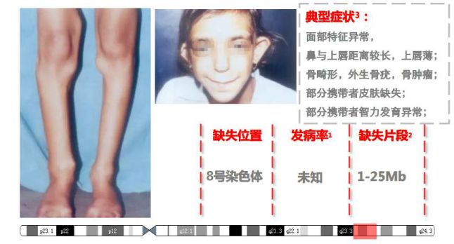 4.cri-du-chat综合征(猫叫综合征)5.angelman综合征(天使综合征)6.