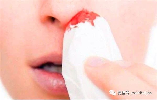 孕妇流鼻血怎么办