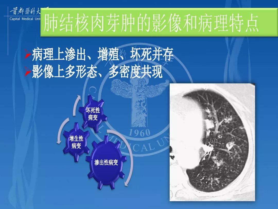 结核性肉芽肿结节的影像特点和鉴别诊断