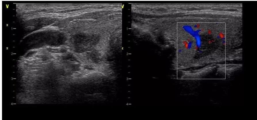 甲状腺结节的良恶性鉴别:让彩色多普勒血流信号见鬼去
