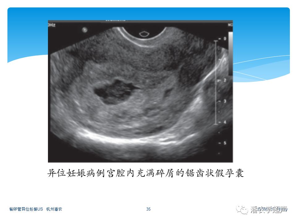 【超声微课堂】输卵管异位妊娠超声诊断思路