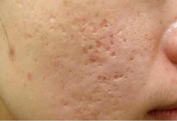 粉刺是什么样子图片 b401c640c8b542febdff7bb0b50d05c2.jpeg