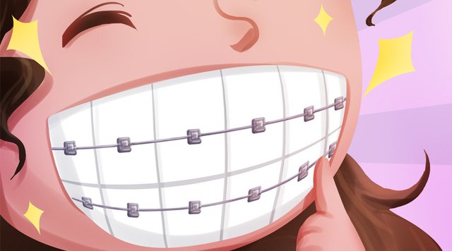 做牙齿矫正的时候选择什么牙套合适