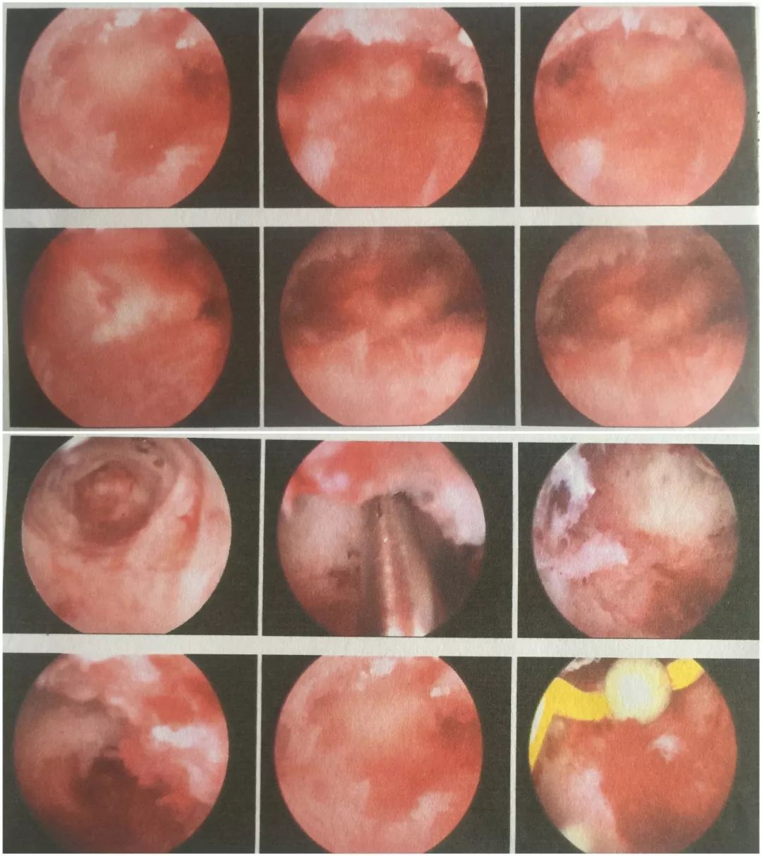 【妇科在线】宫腔镜微创解决重度宫腔粘连