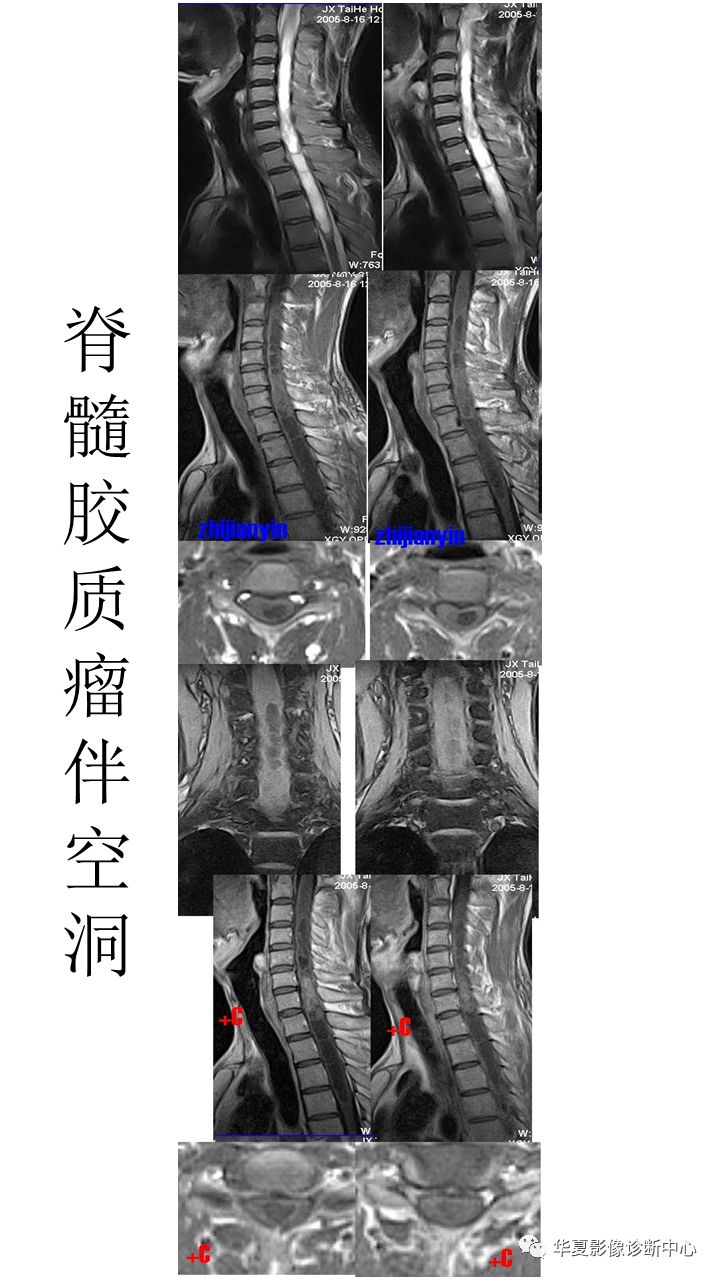 脊髓空洞症临床及影像学表现