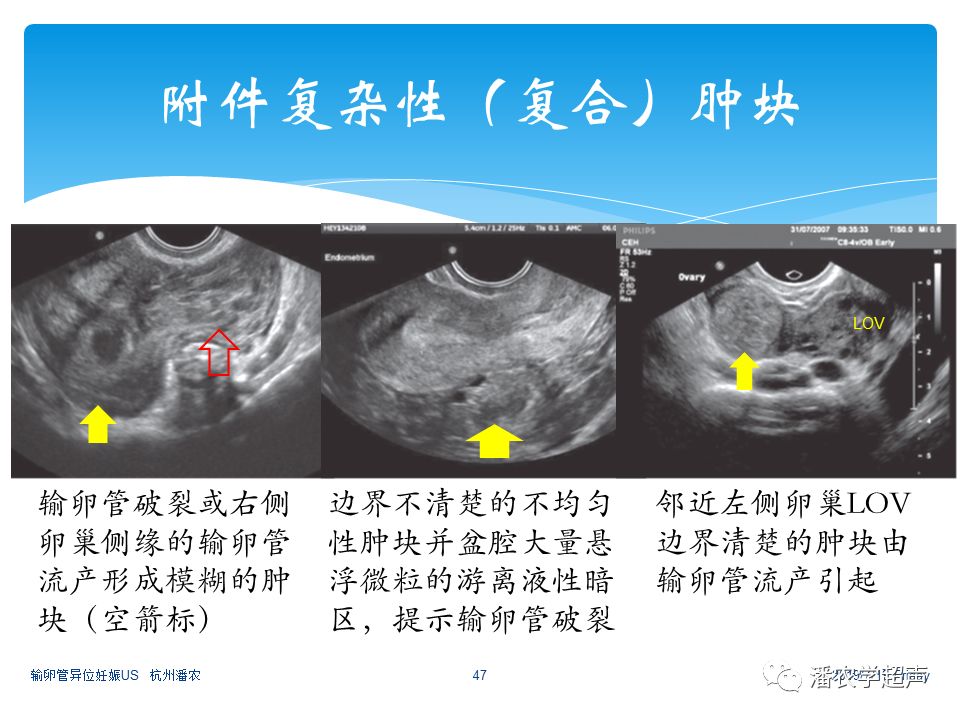 【超声微课堂】输卵管异位妊娠超声诊断思路