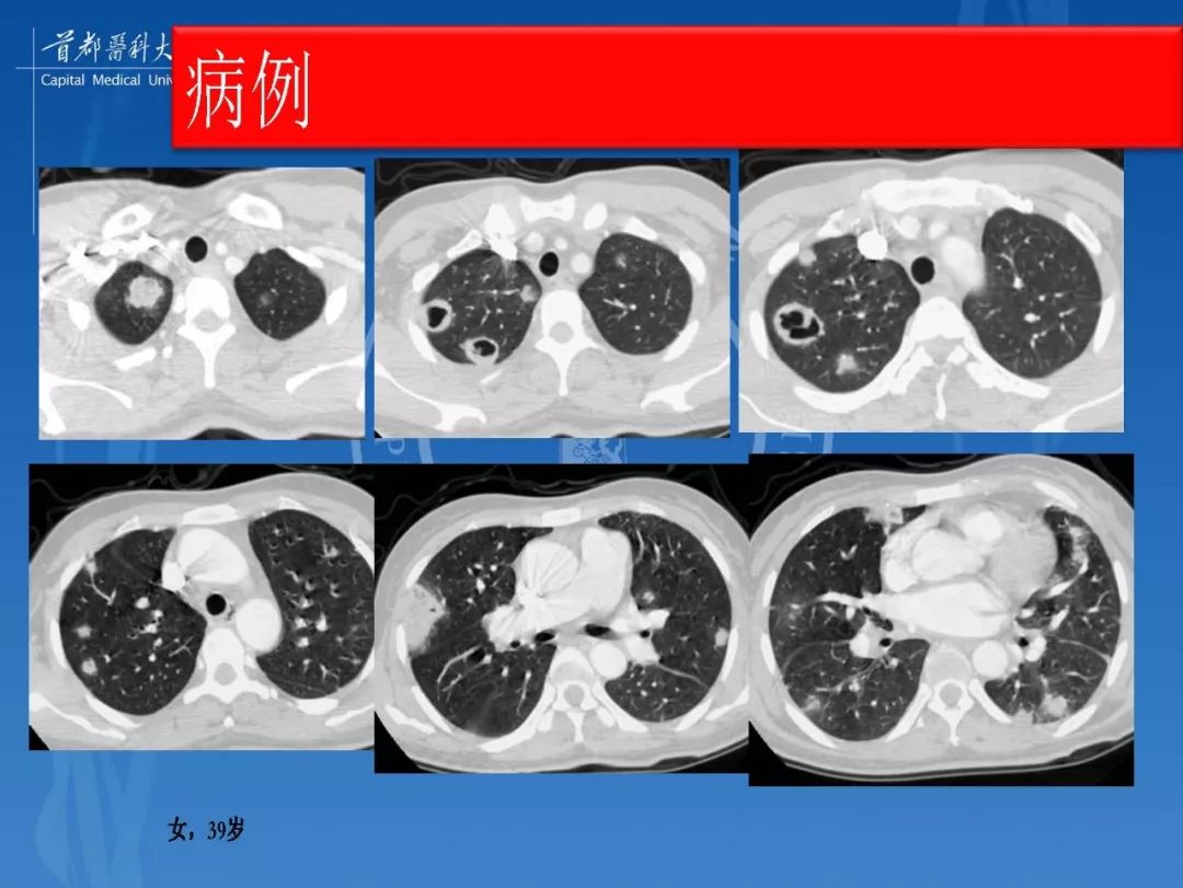 结核性肉芽肿结节的影像特点和鉴别诊断