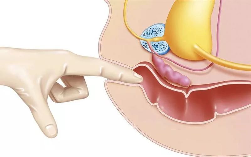 体检时八成人拒绝做直肠指检,却不知它能在2分钟内查出80%的直肠癌!