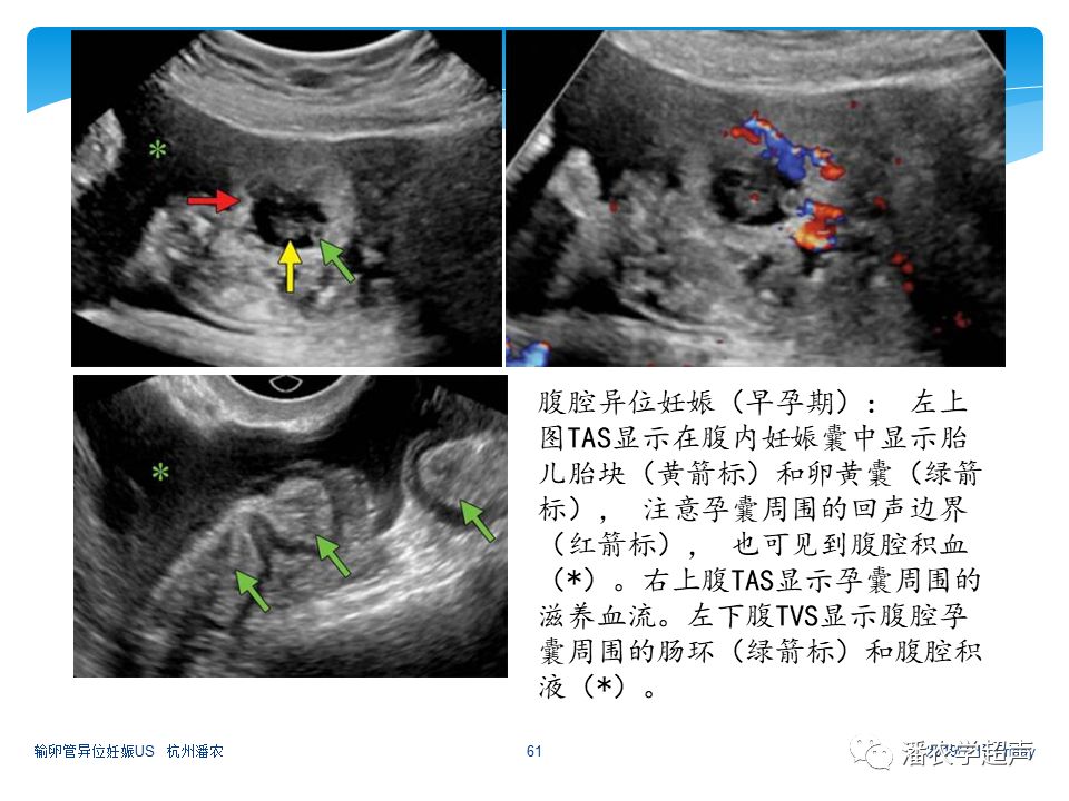 【超声微课堂】输卵管异位妊娠超声诊断思路