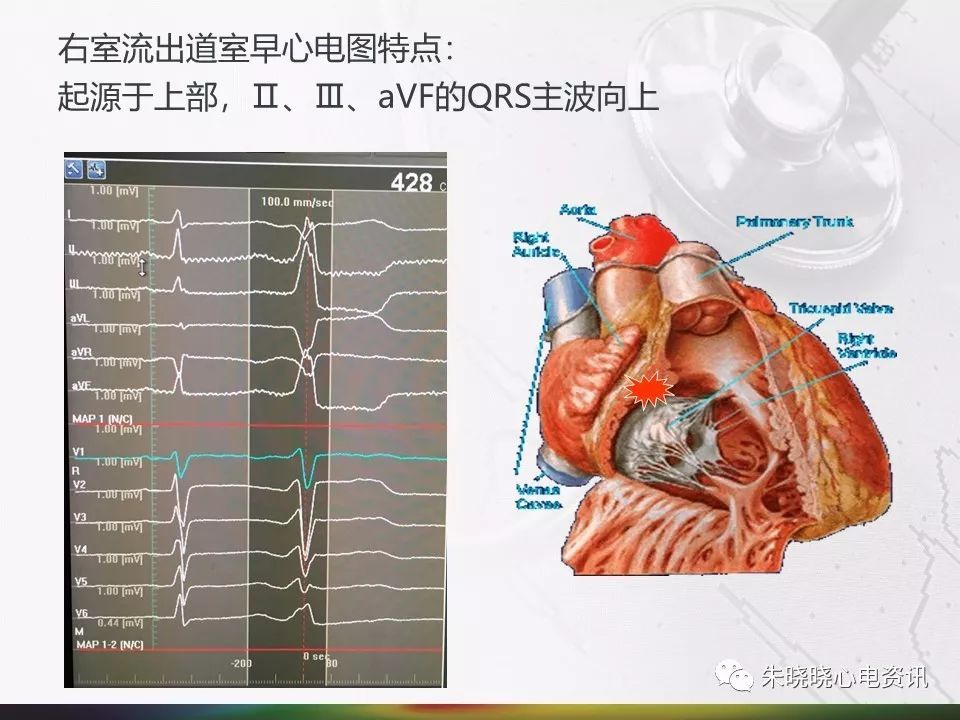 心脏电生理二十三射频消融术介绍ppt