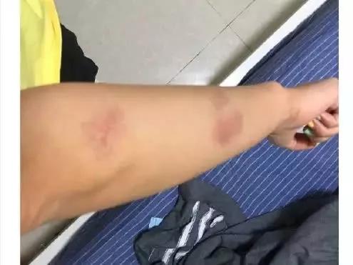 女歌手不堪家暴控诉男友罪状,曾被掰断手指,分手被打25个耳光