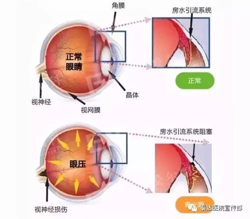 做眼睛近视手术的原理_做近视手术前必须要做眼部检查,医生根据检查的结果,评估你是否适合(2)