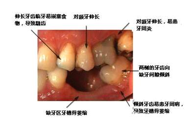 拔牙的人口_拔牙图片卡通(3)