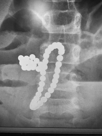 又是磁力珠：5岁男孩吞下46颗，胃肠十处穿孔住进ICU