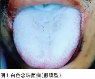 毛状白斑在hiv感染及艾滋病患者中,是发生率仅次于念珠菌病的常见的