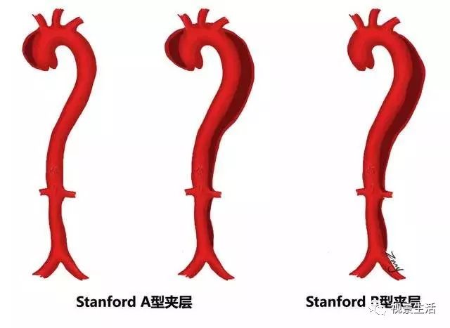 什么是动脉夹层的早期症状 057b35899ba84a8fb7ffaaeaab3676ea.jpeg
