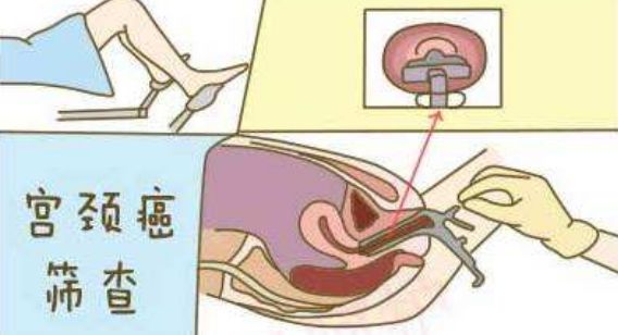 【关注】哪些人该做宫颈癌筛查?说不定就有您!_检查