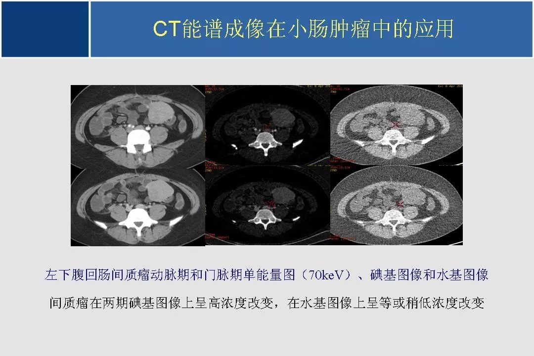 小肠的ct,mr影像诊断及进展丨影像天地