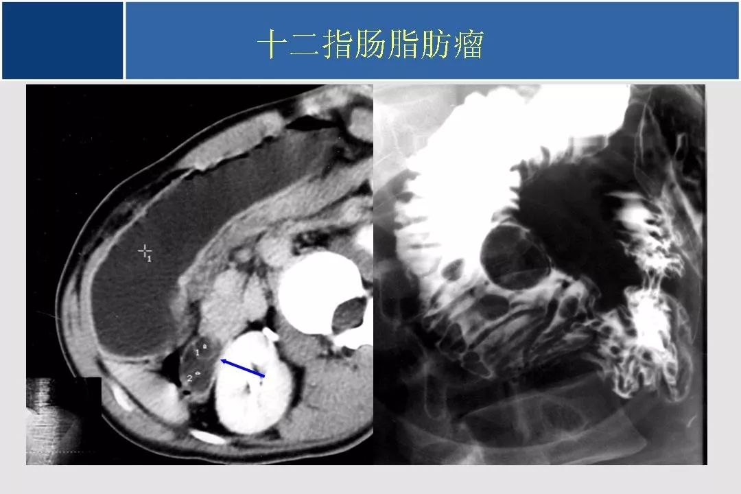 小肠的ct,mr影像诊断及进展丨影像天地