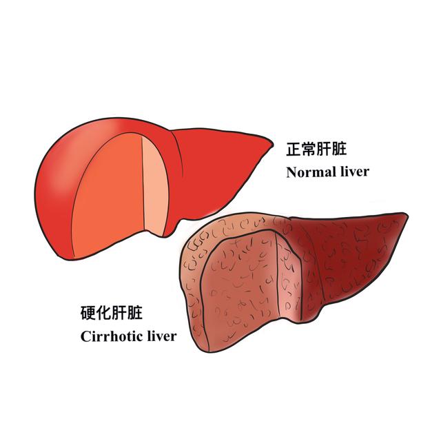 乙型肝炎患者如何早期发现肝硬化