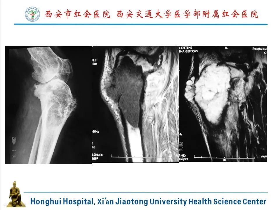 软骨母细胞瘤影像诊断与鉴别诊断丨影像天地