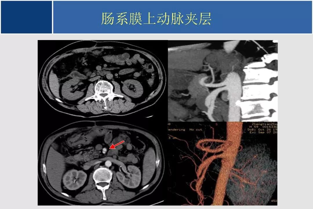 小肠的ctmr影像诊断及进展丨影像天地