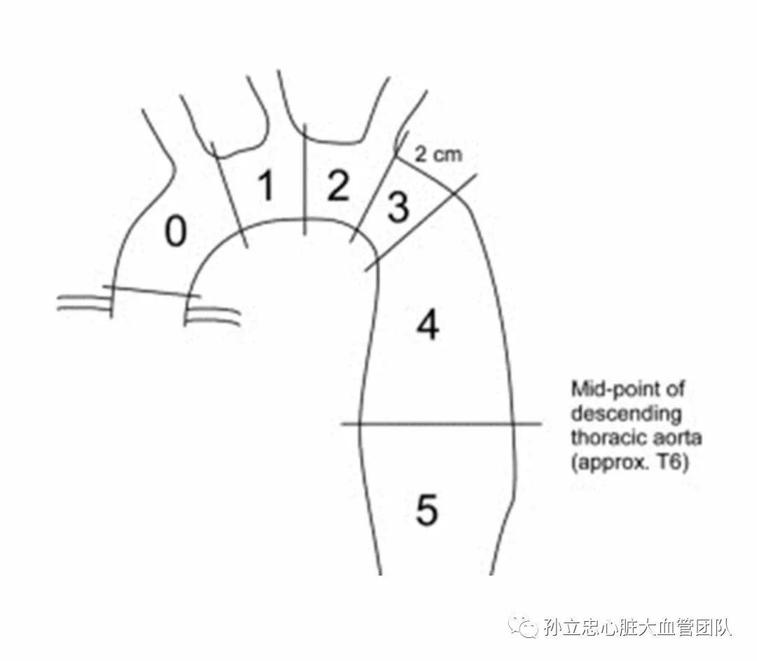 0区:窦管交界至无名动脉起始部远端; 1区:无名动脉起始部远端至左颈