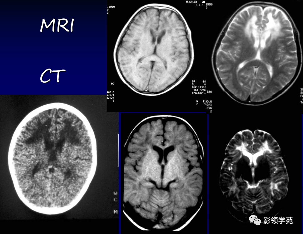 mri表现很具特征性,表现为双侧额叶侧脑室前角周围的脑白质对称性长
