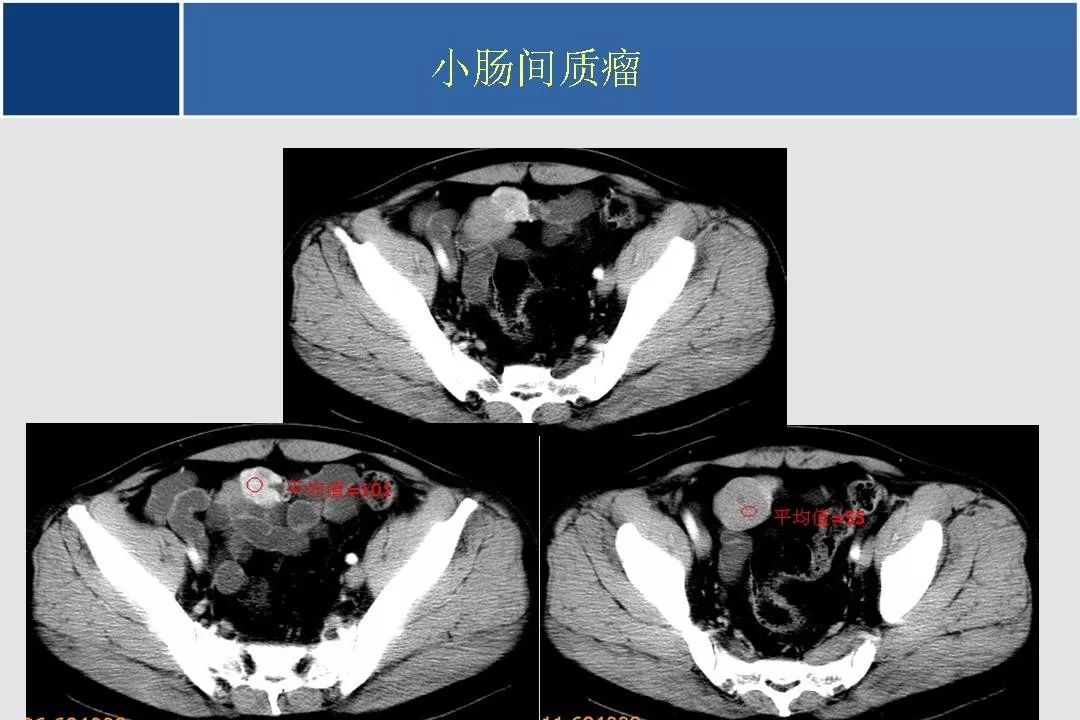 小肠的ctmr影像诊断及进展丨影像天地