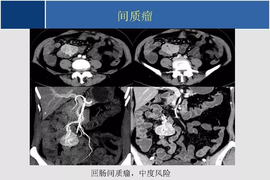 小肠的ctmr影像诊断及进展丨影像天地