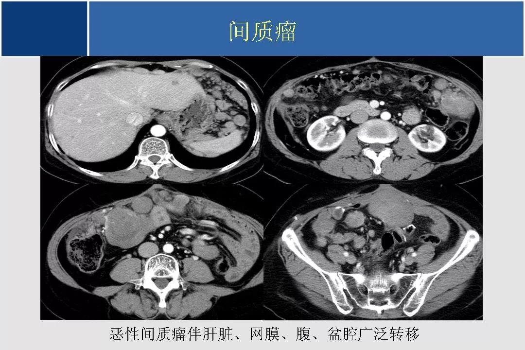 小肠的ct,mr影像诊断及进展丨影像天地