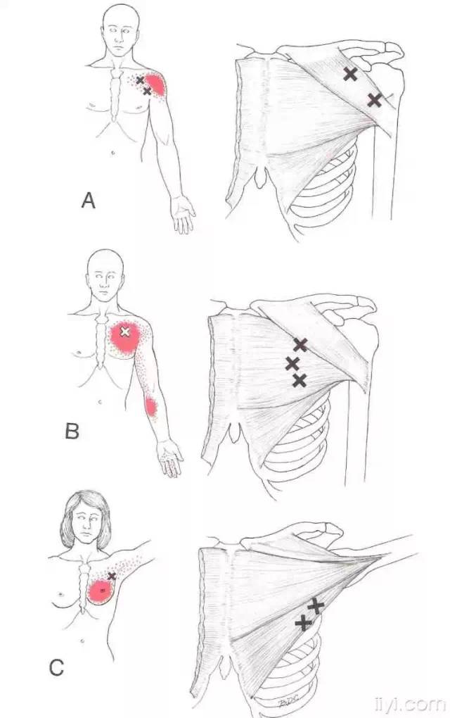 肌筋膜触发点详细图谱建议收藏
