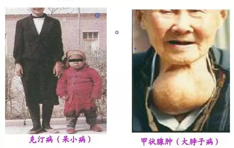 甲状腺疾病高发是碘过量专家碘盐不背这口锅