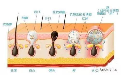 25岁之前一定要搞清楚毛孔粗大三种类型,让你的皮肤细腻光滑